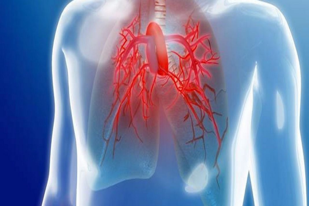 La hipertensión pulmonar se agrava por diagnósticos..