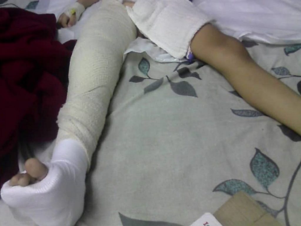 pierna fractura femur