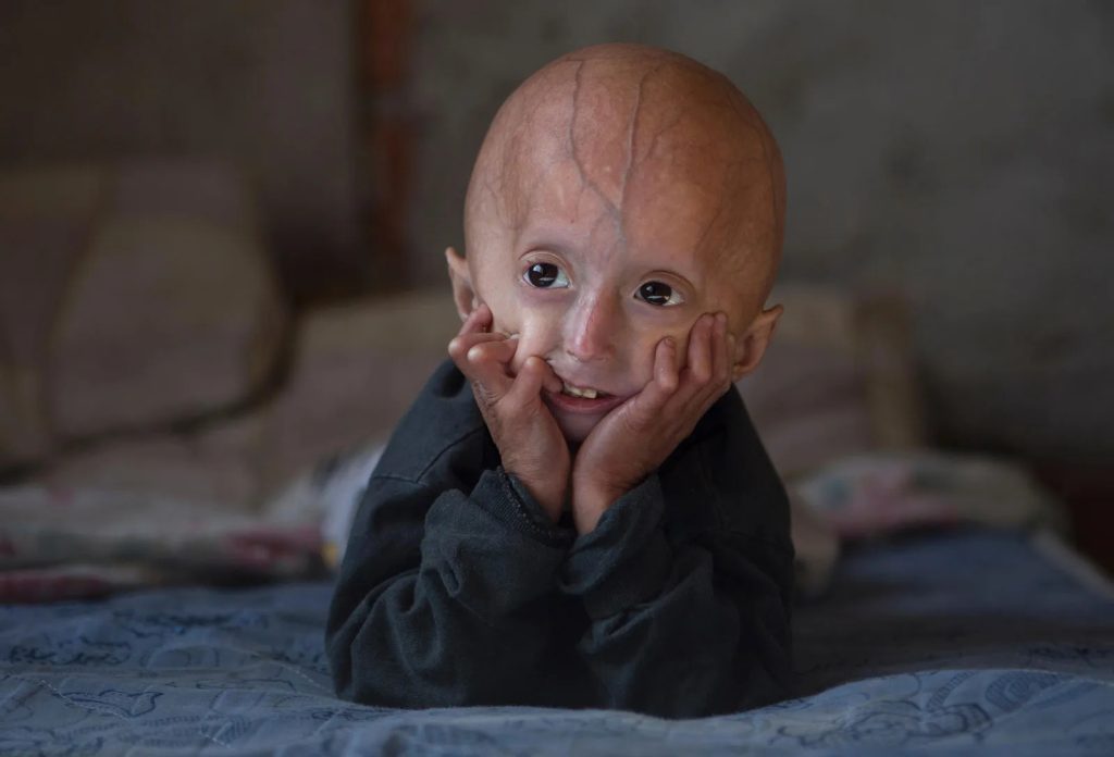 Un equipo internacional de investigadores españoles logró identificar las células clave para prevenir la aterosclerosis en las personas que sufren el síndrome de progeria.