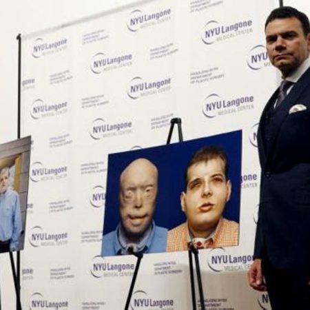 Cirujano que hizo trasplante de rostro evita tentaciones de ego