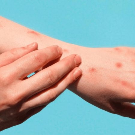 Un estudio identifica nuevos síntomas clínicos de la viruela del mono